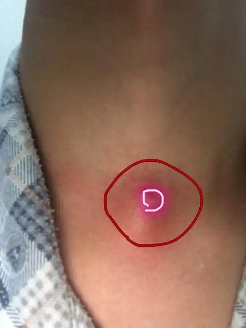 脖子皮肤下面有个很大的肉包,会有些疼,之前感觉像是长腿蚊子咬的