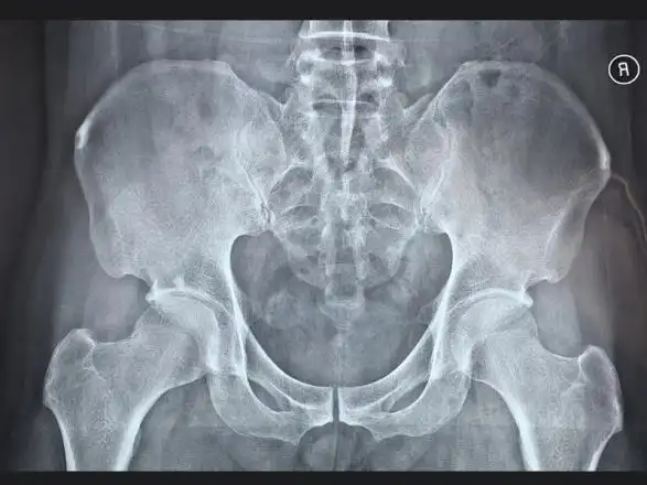 36岁宝妈患强直性脊柱炎,中西医结合治疗效果值得肯定-有来医生