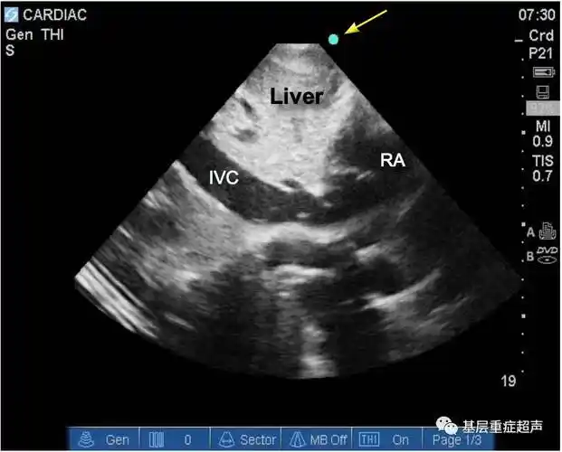超声心动图切面介绍胸骨旁长轴胸骨旁短轴心尖切面剑突下切面