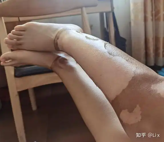 25好啦,就记录到这啦,以后我会陆续更新滴……夏季是烧烫伤的高发季节