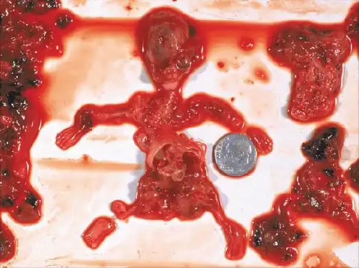 堕胎的时候,有什么事情发生?——残忍.慎入.