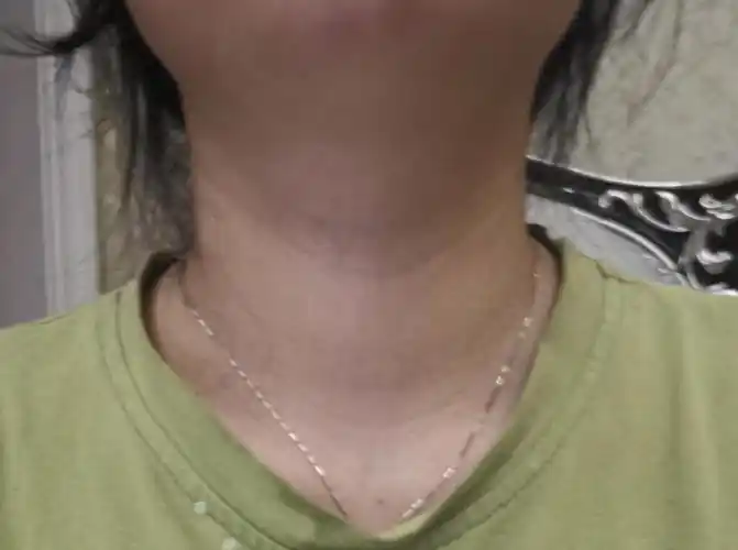 请大家帮我看一下我脖子有没有肿大呀谢谢啦