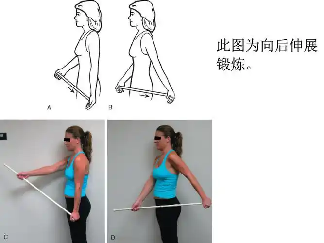 钙化性冈上肌腱炎及术后功能锻炼 - 好大夫在线