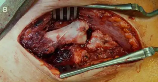 胸锁关节脱位:从解剖到治疗全面阐述!