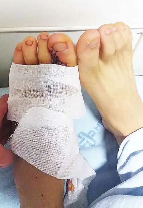 脚趾再造的拇指一样好用