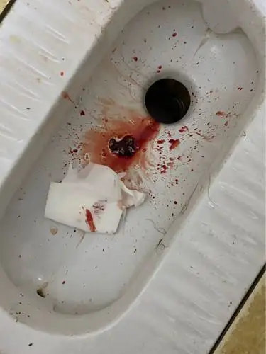 [试管婴儿]怀孕两个月突然大出血.还流