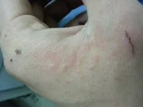 孕妇疥疮初期腹部皮肤症状图片