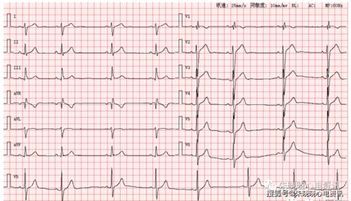 每日读图 || 第1178期 窦不齐 窦缓 不完全性右束支传导阻滞_手机搜狐