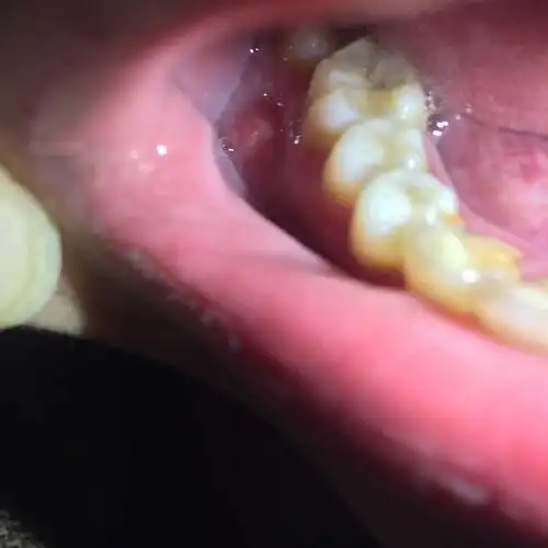 牙龈旁边长个大脓包都一两个月了,肿了,特别疼怎么办啊