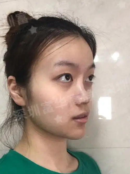 术前诊断术前患者山根低平,鼻梁部位塌陷,鼻翼较宽,_圈子-新氧美容