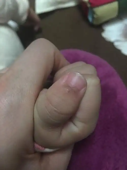 两岁宝宝大拇指指甲根部发黑是怎么回事?如图