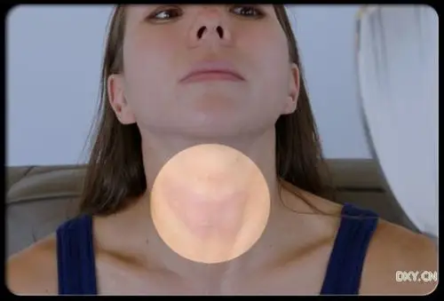 甲状腺肿大有什么反应 甲状腺肿块医保