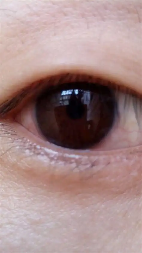 眼睛白眼球上有白点眼睛白眼球上有白点图片2022已更新今日更新