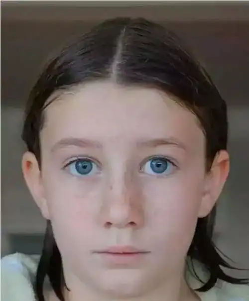 7)经常晒太阳形成的日晒斑也是黄褐斑的一种.