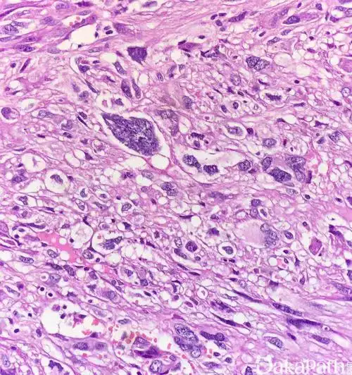 肿瘤细胞凝固性坏死和核分裂相多为中老年人见于子宫,软组织,腹膜后