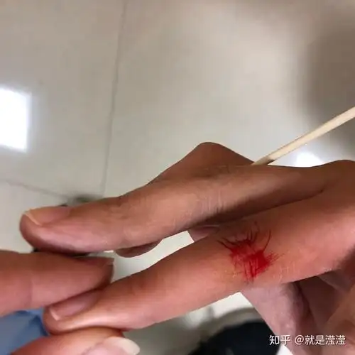 被乙肝病人针头扎到手