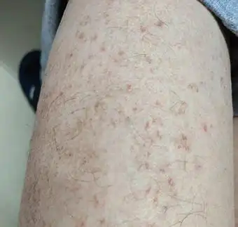 腿部湿疹症状及病因