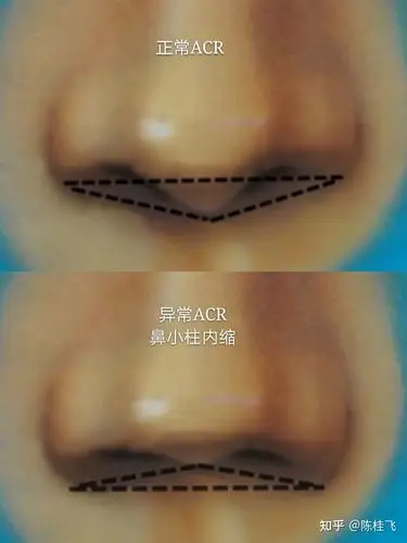 而有的人会有鼻小柱内陷,鼻小柱过度外凸,鼻小柱过短的情况,调整鼻翼