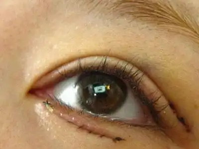 倒睫毛怎么治疗