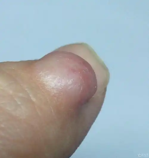 看图是手指粘液样囊肿吗