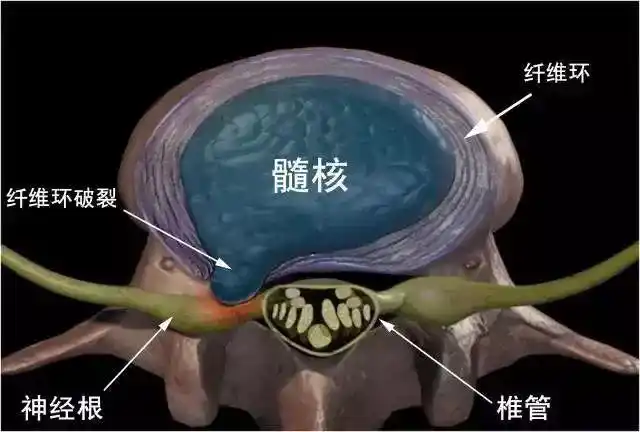 颈肩腰腿痛,腰椎间盘突出,行家教你一招搞定.