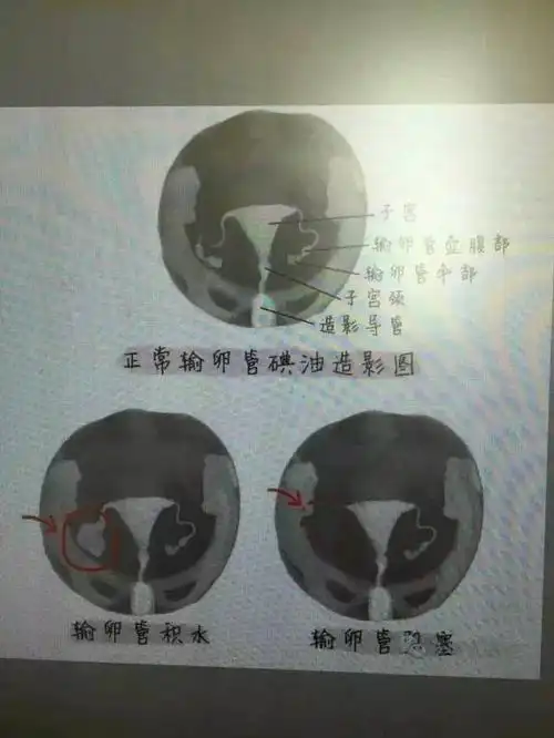 博士微讲堂 | 输卵管通水和输卵管造影大pk!它们到底谁更牛?