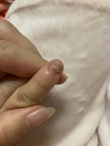 五岁小孩指甲一层层脱落是什么问题啊?