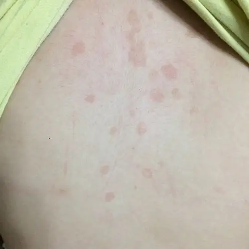 背上最近出现红斑,不痛不痒,没有任何感觉,但是感觉在扩散,越来越