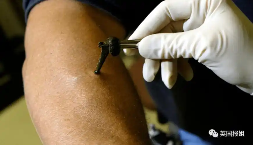 吓坏了!5岁男孩被蚂蟥寄生一年,这种虫还会钻眼珠,吸人血