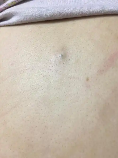 后背长了一个脓包搁一段时间就能挤出一些味道很难闻的脓什么原因