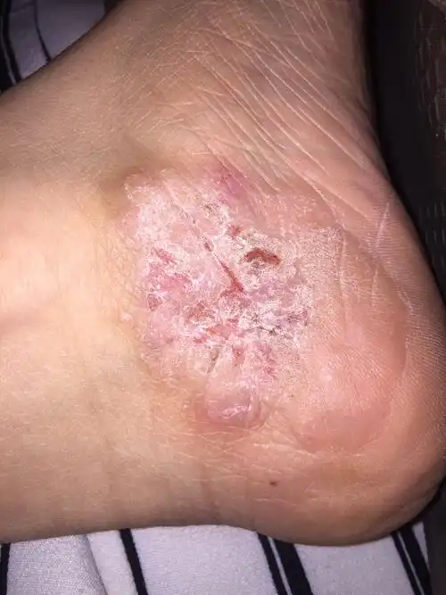 好尴尬 平时是茧一样的一大块硬皮 泡完脚变成这样 水干了 就变成图二