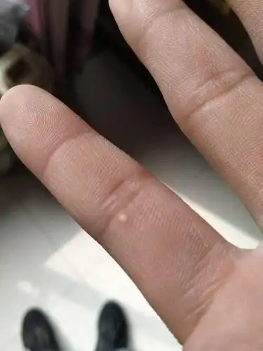 手指上长了个白豆怎么回事啊