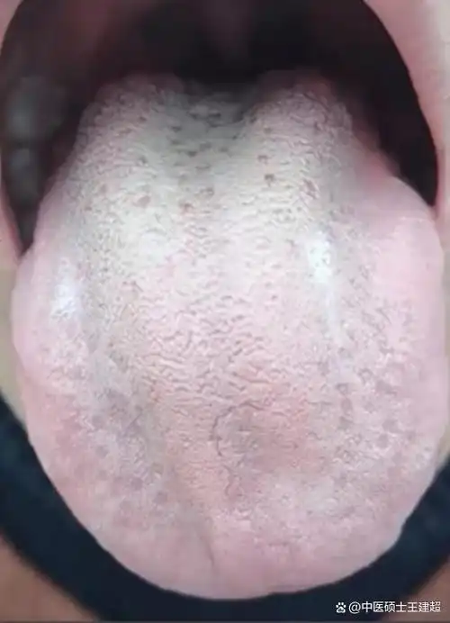 舌诊分析:舌头发白,体弱无力,手脚冰凉,到底是怎么回事?