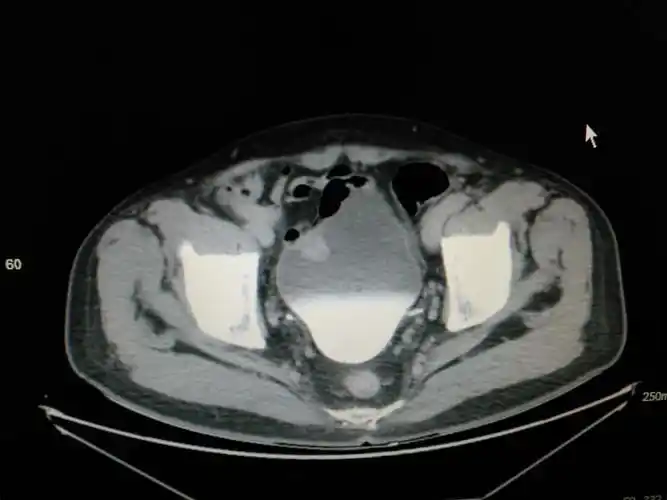 "针状电极t2期膀胱肿瘤剜除术"一例分享——术者:兰大二院尚攀峰