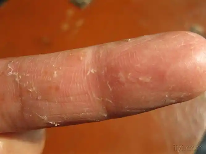 是手足癣吗? - 皮肤及性传播疾病讨论版 - 爱爱医医学论坛