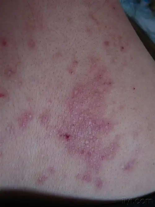 女患者的颈背部---------神经性皮炎