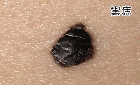 判断图片周围颜色_王伟:如何判断"痣"是否恶变?丨科普篇