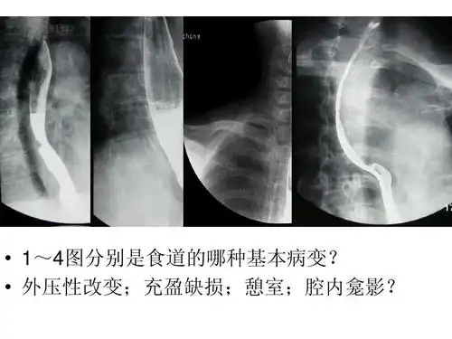 外压性改变;充盈缺损;憩室;腔内龛影?