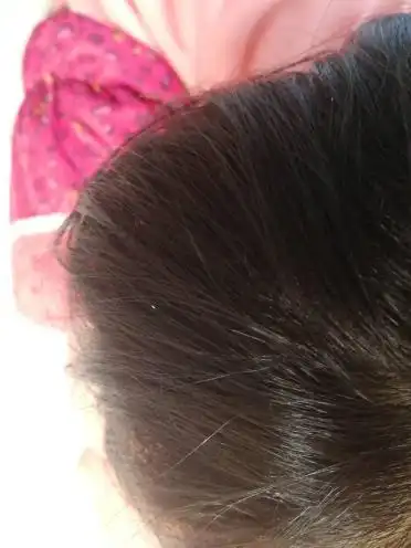 头发上长了白色的小点