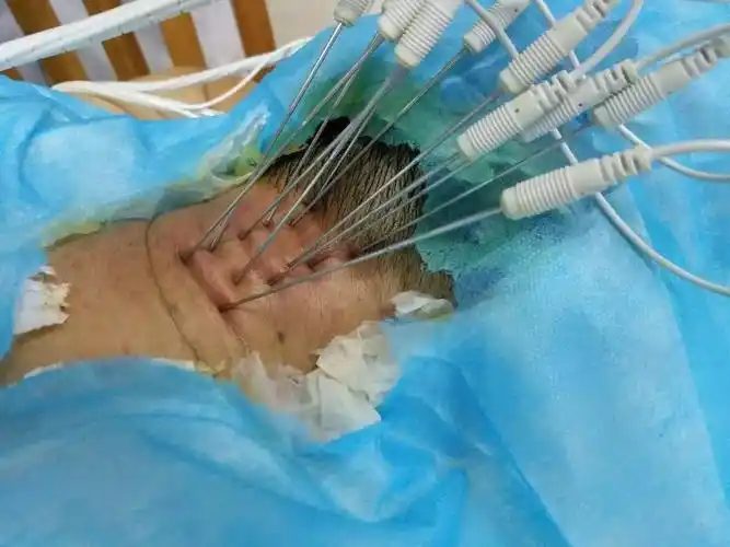 内热针巧治颈椎病