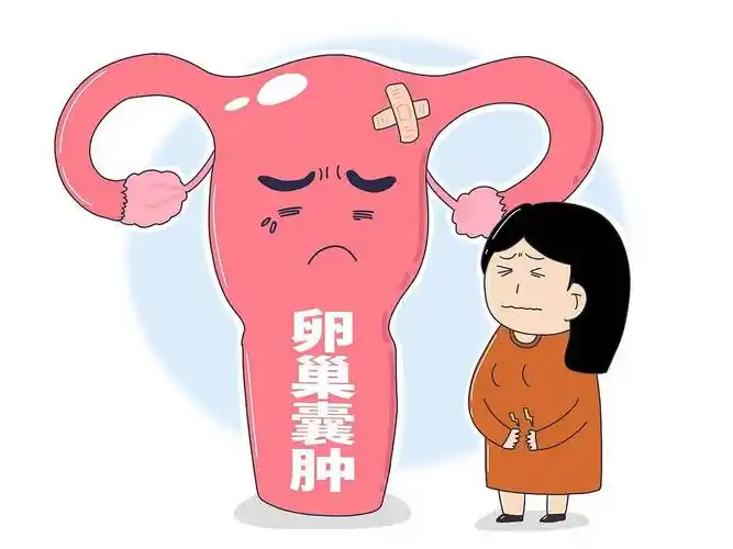 卵巢囊肿会导致不孕上海衡山虹妇幼医院