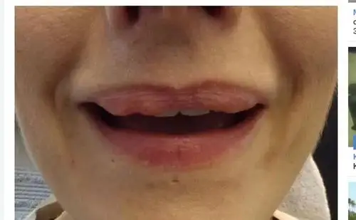 就以嘴唇举例,如果丰唇的手术不当,不仅会造成组织坏死,恐怕还有失明