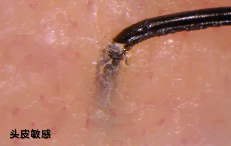 (四)过敏性头皮——敏感头皮4.