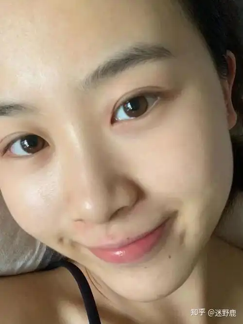 完成了从芝麻草莓鼻到牛奶鼻的完美逆袭!康康我以前的鼻子!