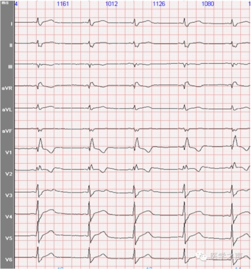 心电图课堂|第29期:完全右束支传导阻滞