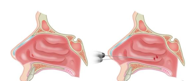 为什么你的临床报告中会出现鼻甲肥大