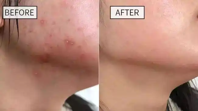 10万螨虫在你脸上用ta一洗杀菌除螨15天痘痘粉刺黑头都不见了