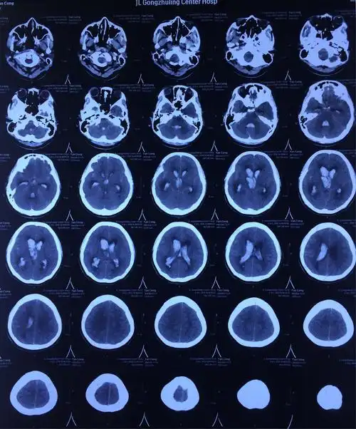 闫聪,女,16岁,右侧基底节出血破入脑室