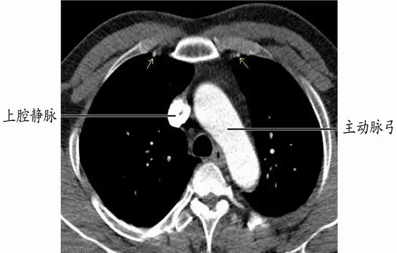 正常心脏大血管ebct增强扫描影像学表现-医学影像图