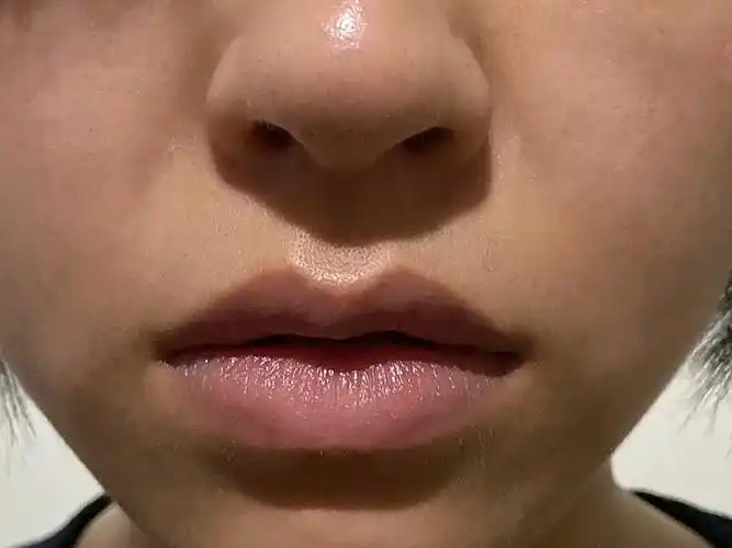 我的唇珠不显,唇弓没有明显弧度,唇形不够精致,非常_圈子-新氧美容